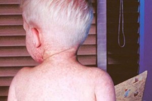 Foto de arquivo de uma criança com sarampo. The Canadian Press / HO-Os Centros dos EUA para Controle e Prevenção de Doenças