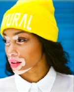 JOVEM CANADIANA COM VITILIGO CONQUISTA LUGAR DE TOP MODEL