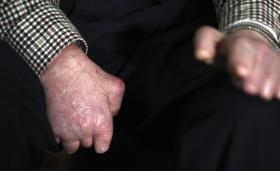 MINISTRO DA SAÚDE ANGOLANO PREOCUPADO COM AUMENTO DE LEPRA NO PAÍS