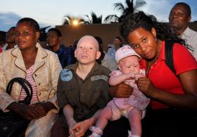 MOÇAMBIQUE PREOCUPADO COM CRIMES CONTRA ALBINOS
