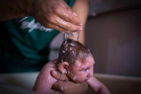 PROVAS CRESCENTES DA RELAÇÃO DE ZIKA COM MICROCEFALIA, MAS CERTEZAS SÓ EM JUNHO – OMS