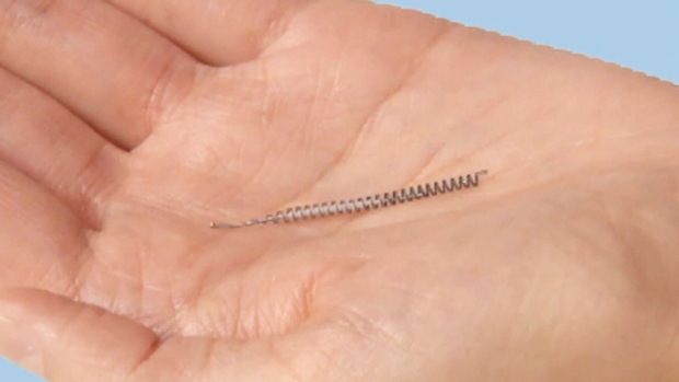Implante de controle de natalidade chamado Essure. (Bayer Healthcare Pharmaceuticals, Inc. via AP)