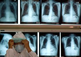 PNEUMONIA MATA SEIS MIL PESSOAS POR ANO EM PORTUGAL