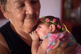 BRASIL AMPLIA CRITÉRIOS DE DIAGNOSTICO DE MICROCEFALIA CAUSADA PELO VIRUS ZIKA