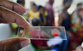 NOVO TESTE SANGUÍNEO DETETA TUBERCULOSE MAIS DEPRESSA E COM MAIS EFICÁCIA