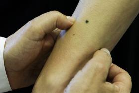 INVESTIGADORES DESCOBREM COMO SINAIS DE PELE BENIGNOS SE TRANSFORMAM EM MELANOMA