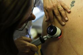 QUASE 100 SUSPEITAS DE CANCRO DE PELE NO RASTREIO NACIONAL DE 2016