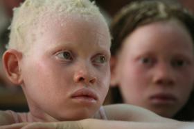 GUINÉ-BISSAU ASSINALA PELA PRIMEIRA VEZ DIA DA CONSCIENCIALIZAÇÃO DO ALBINISMO