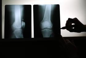 NOVO TRATAMENTO PARA INFEÇÕES ÓSSEAS CURA A PATOLOGIA E REGENERA O PRÓPRIO OSSO
