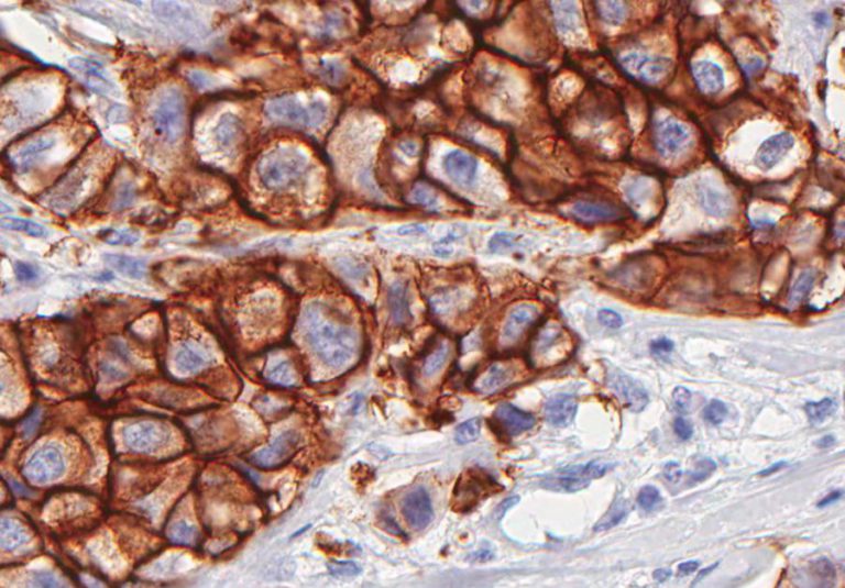 TAXA DE SOBREVIVÊNCIA AO CANCRO TEM AUMENTADO MAS RIQUEZA DETERMINA QUEM CONSEGUE SOBREVIVER