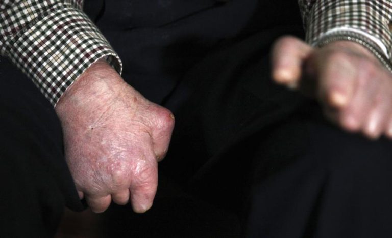 BRASIL E MOÇAMBIQUE ENTRE PAÍSES COM LEPRA EM QUE ONU DIZ SER PRIORITÁRIO AGIR