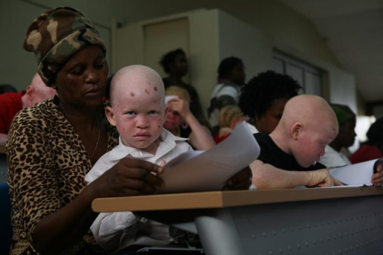 OFTALMOLOGISTAS PORTUGUESES VÃO ASSISTIR GRUPO DE 100 ALBINOS EM MAPUTO