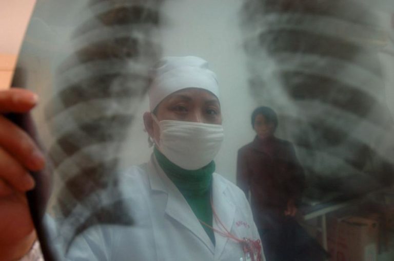 DESCOBERTA NOVA LESÃO PULMONAR LIGADA A CIGARROS ELETRÓNICOS COM LÍQUIDO