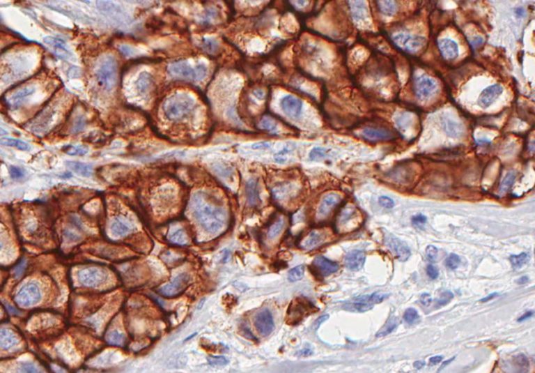 MAIORIA DOS DOENTES ONCOLÓGICOS NUNCA OUVIRAM FALAR DE MUTAÇÕES GENÉTICAS BRCA