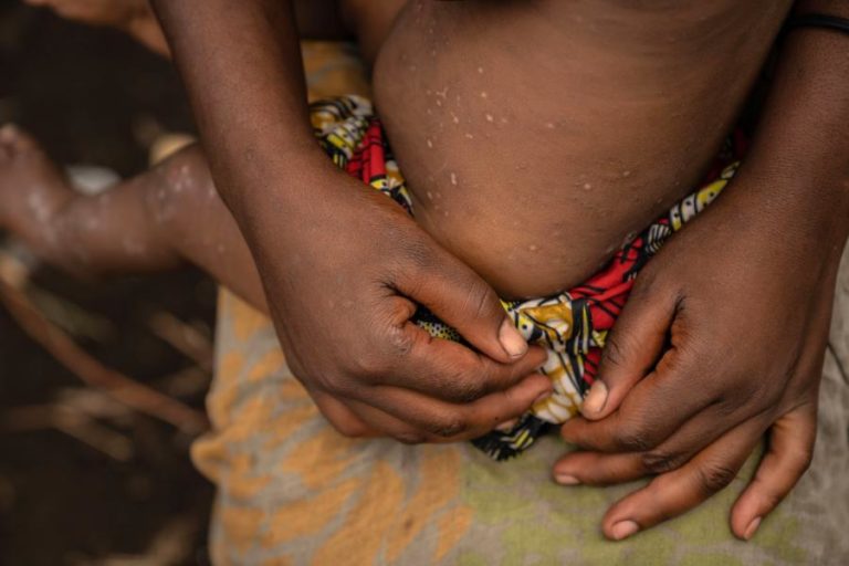 Mais dois doentes e terceira província com casos de mpox em Moçambique