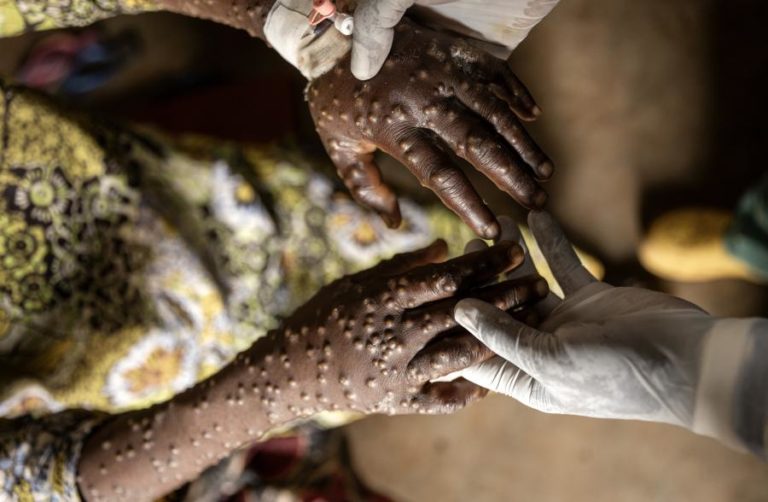 Mais seis casos de Mpox em Moçambique em 24 horas e 170 suspeitos