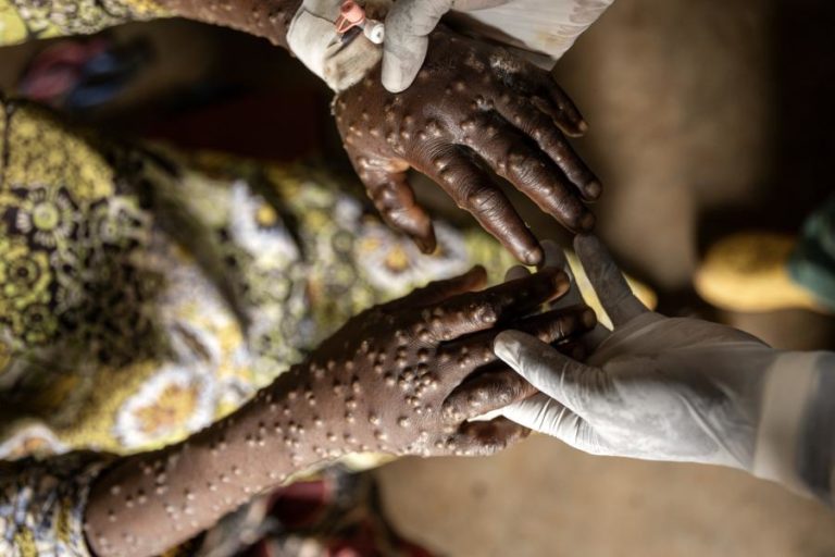 África regista menos casos de mpox, apesar de focos em Moçambique e na RDCongo