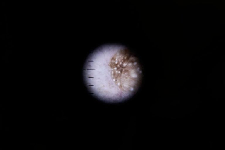 Investigadores do Porto e Minho criam hidrogel para tratar melanoma